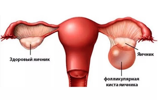 Опасна ли киста яичника при беременности